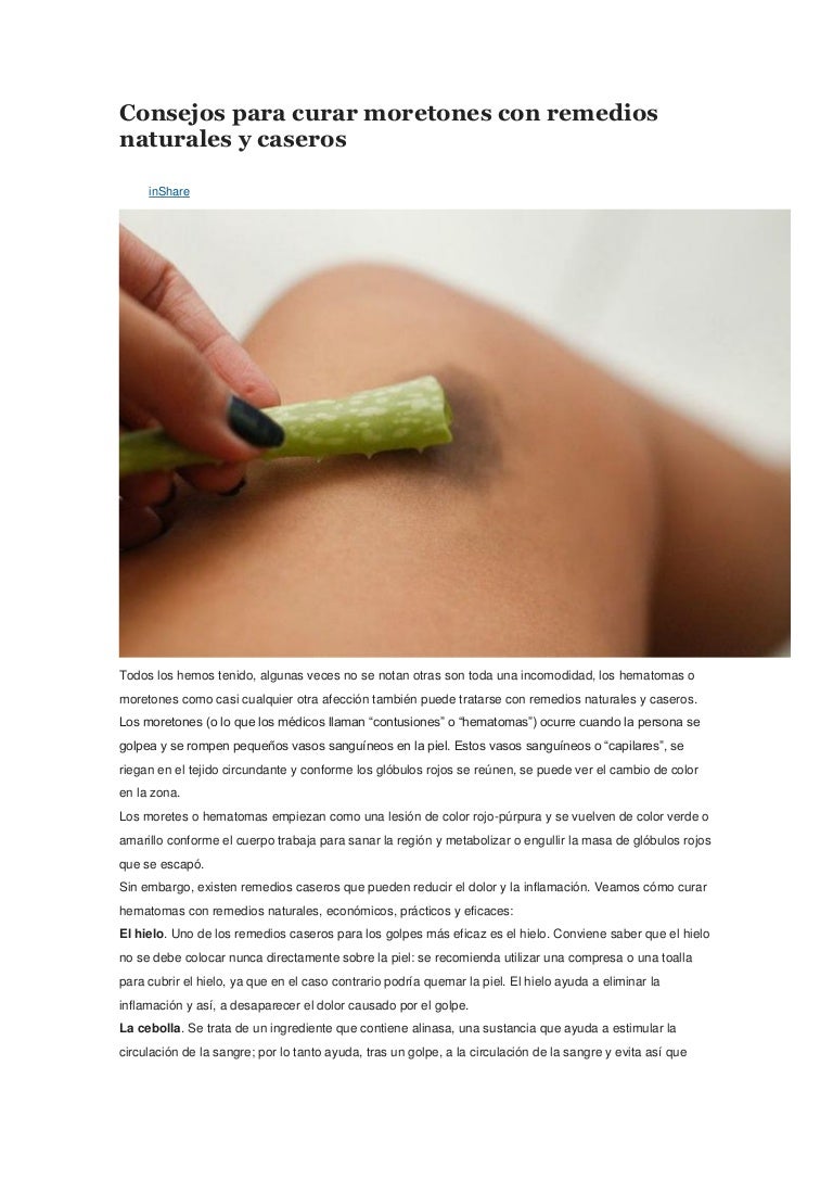 Remedios para moretones por golpes